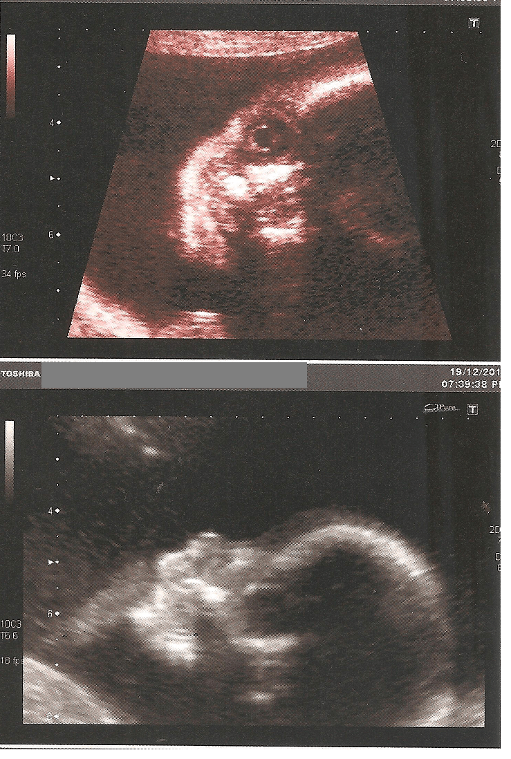 20 semanas: la mitad del embarazo - Mamá (contra) corriente - Granos En La Cara Embarazo Niño O Niña