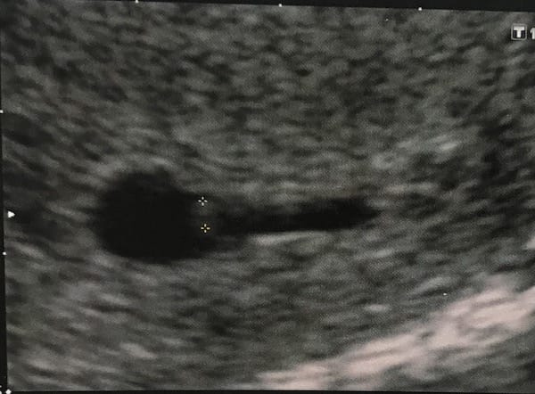 Embrión de seis semanas